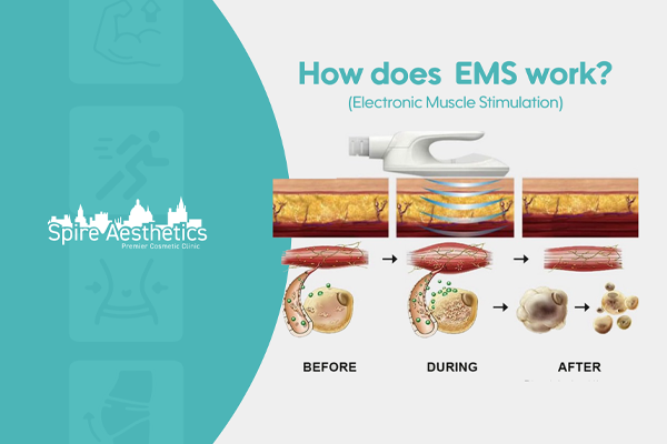 EMS treatment for post pregnancy weight loss treatment Romford