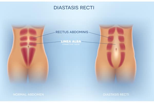 What Non-Surgical Options Are Available for Diastasis Recti Romford?