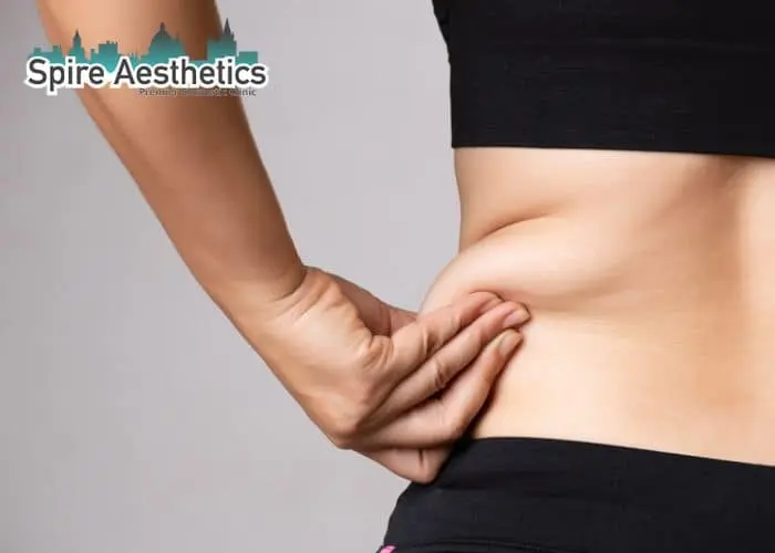 Image of woman pinching fat on their hips Romford. Fat Freezing treatment