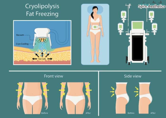 Image of diet and fat freezing combined for best results for Spire Aesthetics Romford