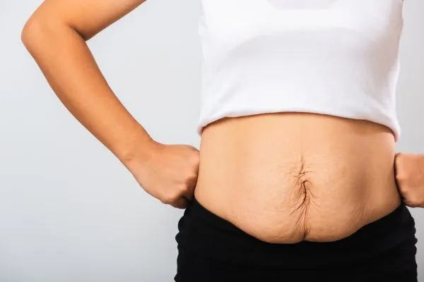 Image of a woman's stomach after weight loss with sagging skin following a gastric band Romford