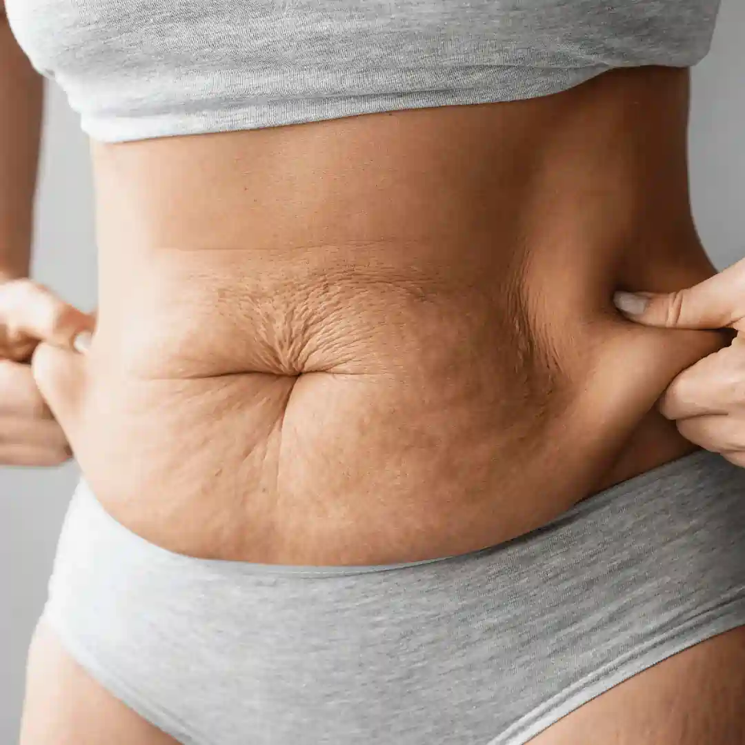 Is It Normal to Have Loose Skin After Pregnancy Romford?
