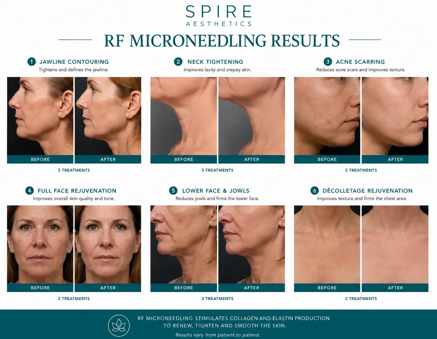 RF Microneedling Skin tightening Romford results