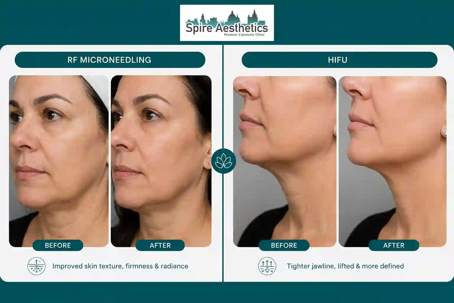 Can RF Microneedling and HIFU Be Combined Romford?