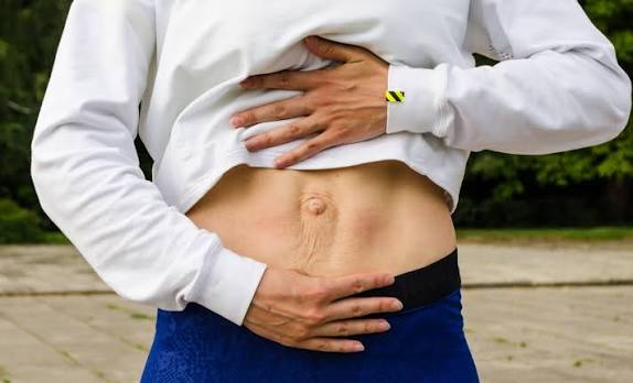 When Could Diastasis Recti Be the Missing Piece of the Puzzle Romford?