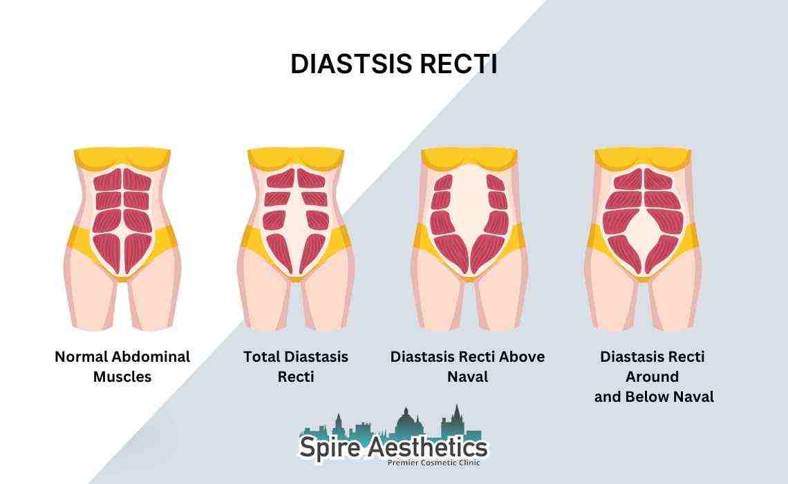Is Non-Surgical Diastasis Recti Treatment Right for You? Common Concerns Answered Romford